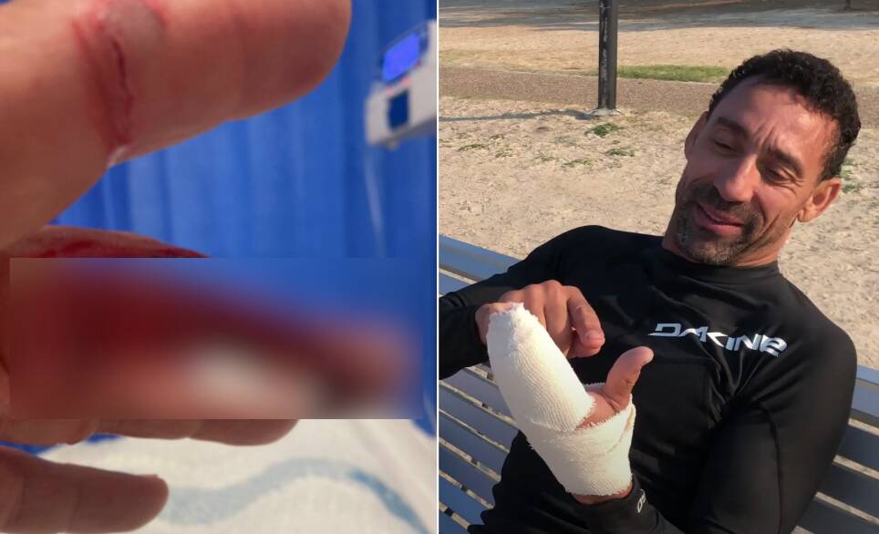 Port Macquaries Chris Munro partially severed a finger in a kitesurfing incident. Pictures supplied